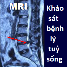 Ảnh 4 của Acute Spinal Cord Injury